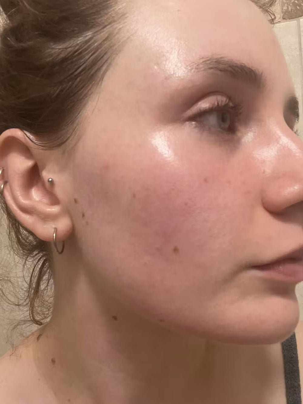 acne SE keep