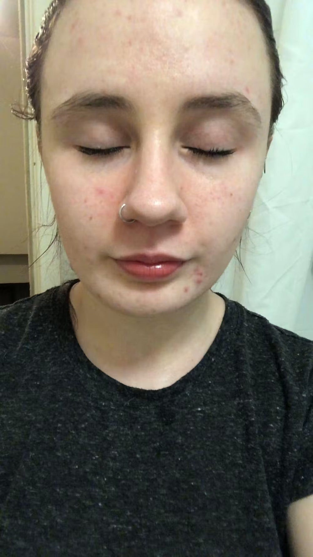 acne SE keep