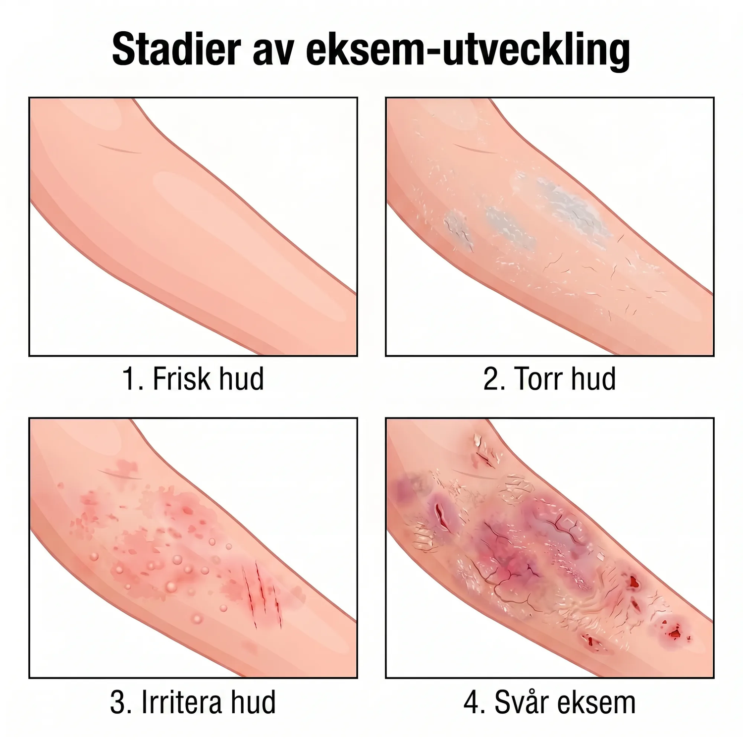 eczema_SE_eczema_4stages_v2.png